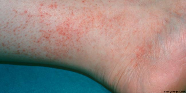 What Is Spotted Fever